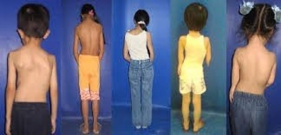Cong vẹo cột sống ở học sinh và cách phòng chống